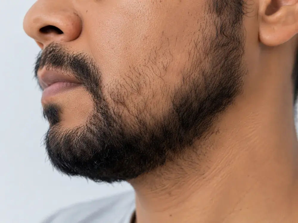 Pessoa com falhas naturais na barba
