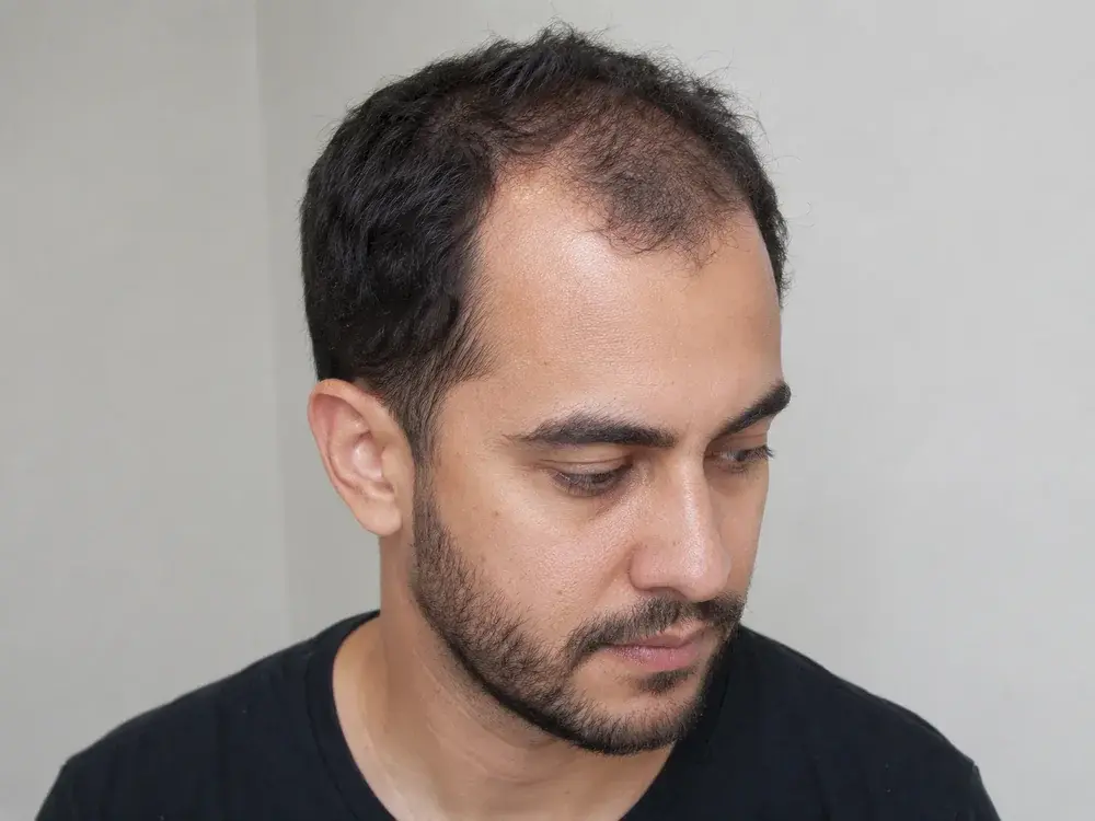 Pessoa com entradas e rarefação capilar